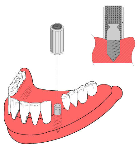 Dental Implant Post Cleaner