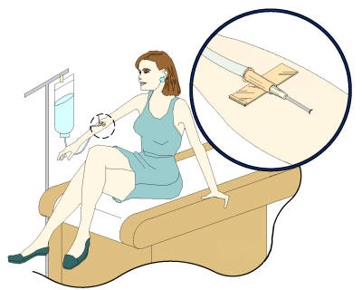 Secure Self Adhering IV Catheter Assembly